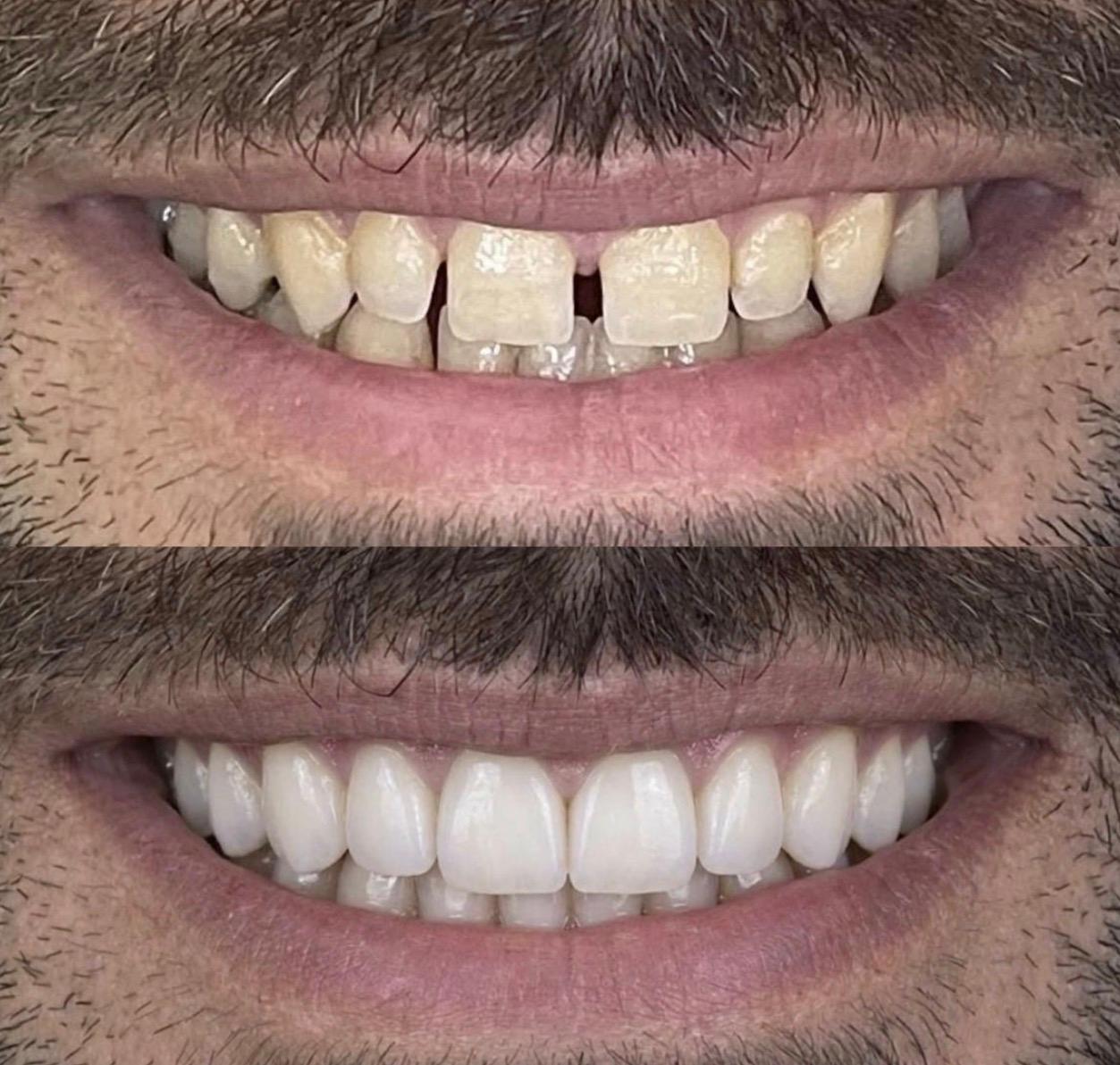 Hasta gülüş dönüşümü 2