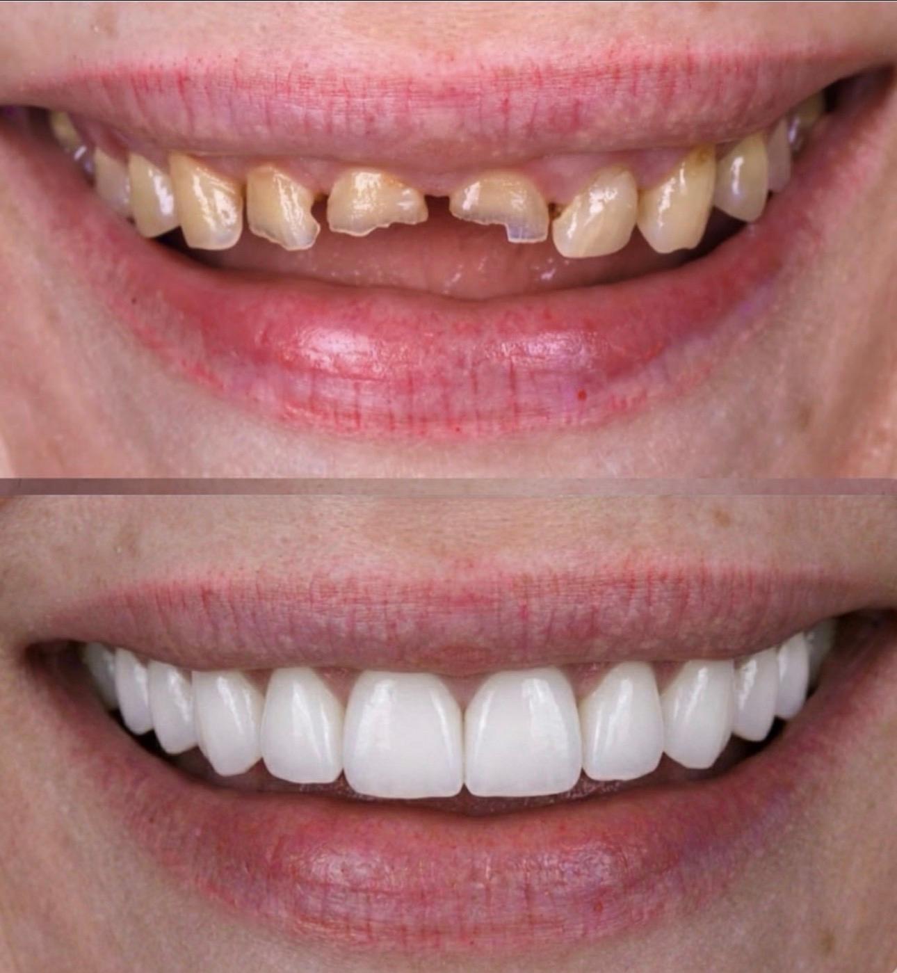 Hasta gülüş dönüşümü 4