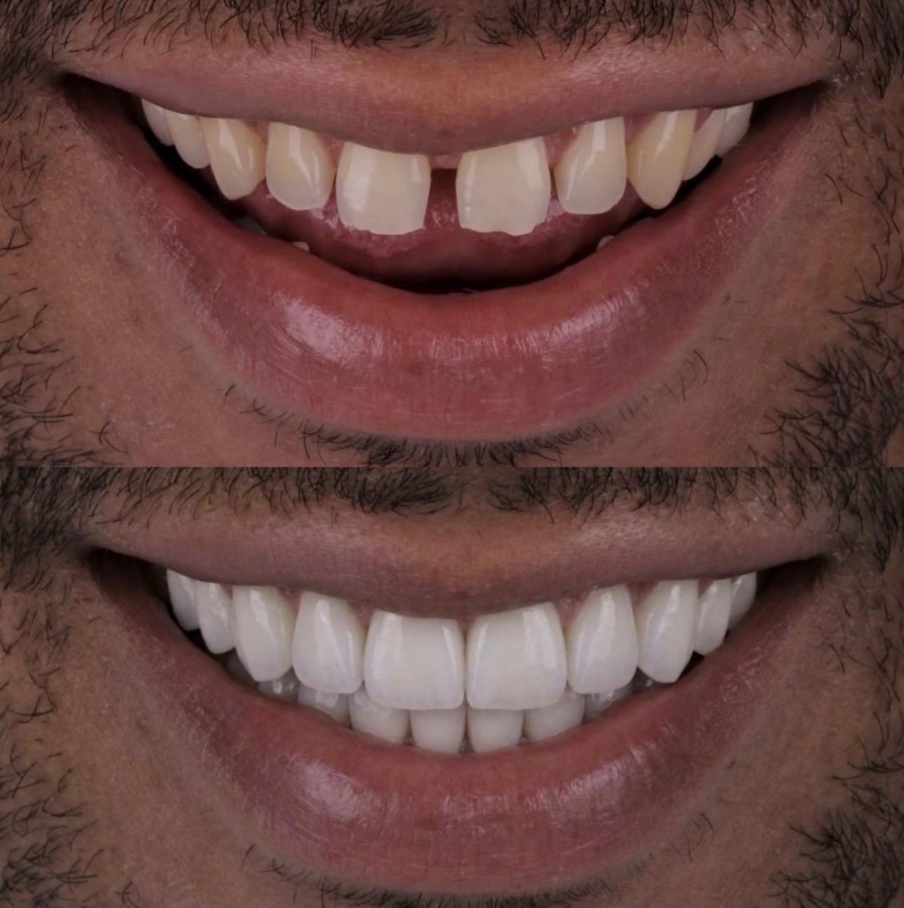 Hasta gülüş dönüşümü 10