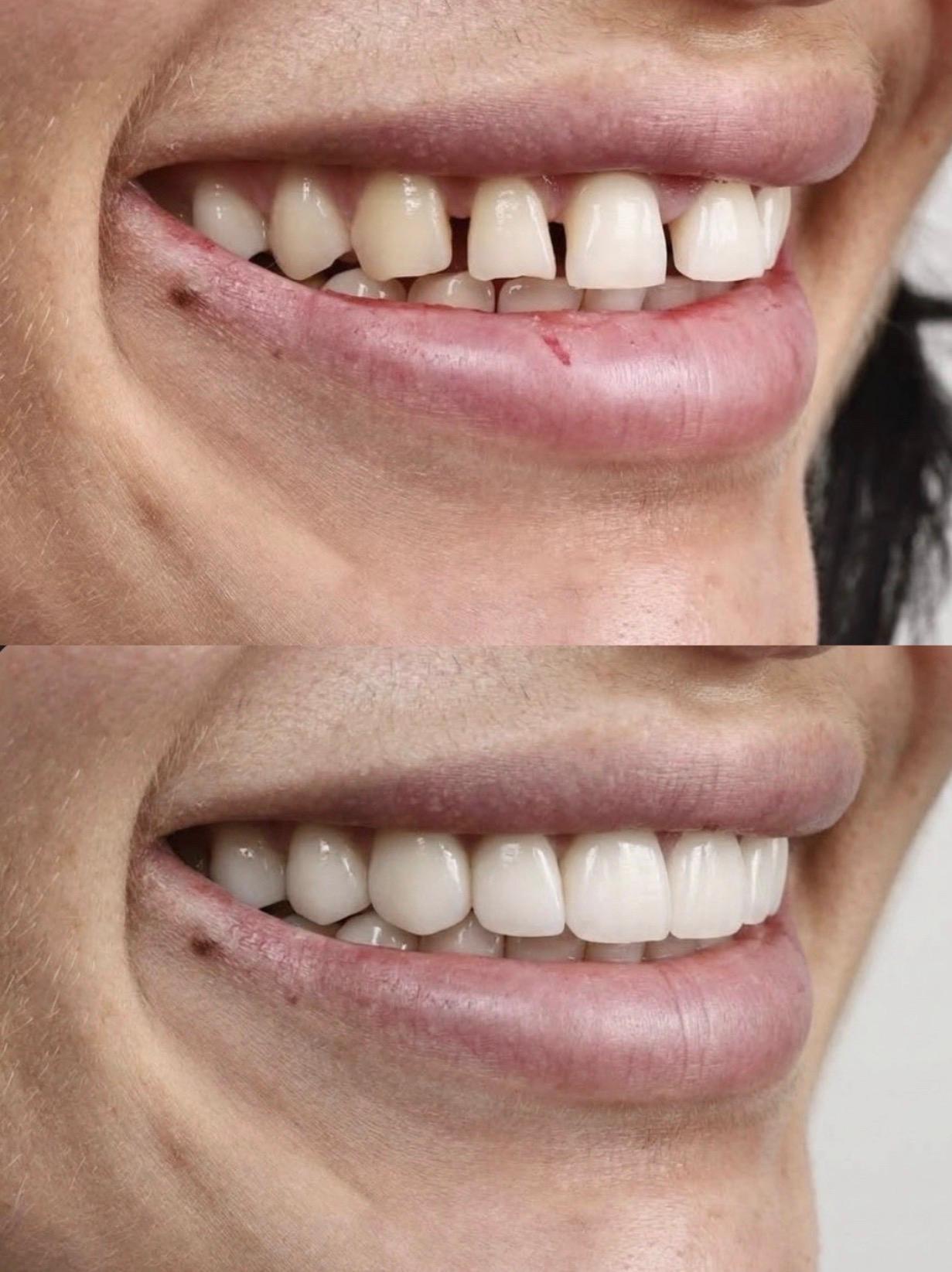 Hasta gülüş dönüşümü 14