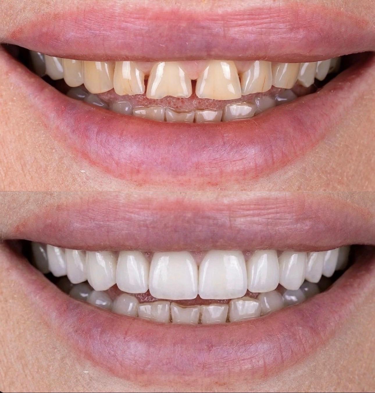 Hasta gülüş dönüşümü 17