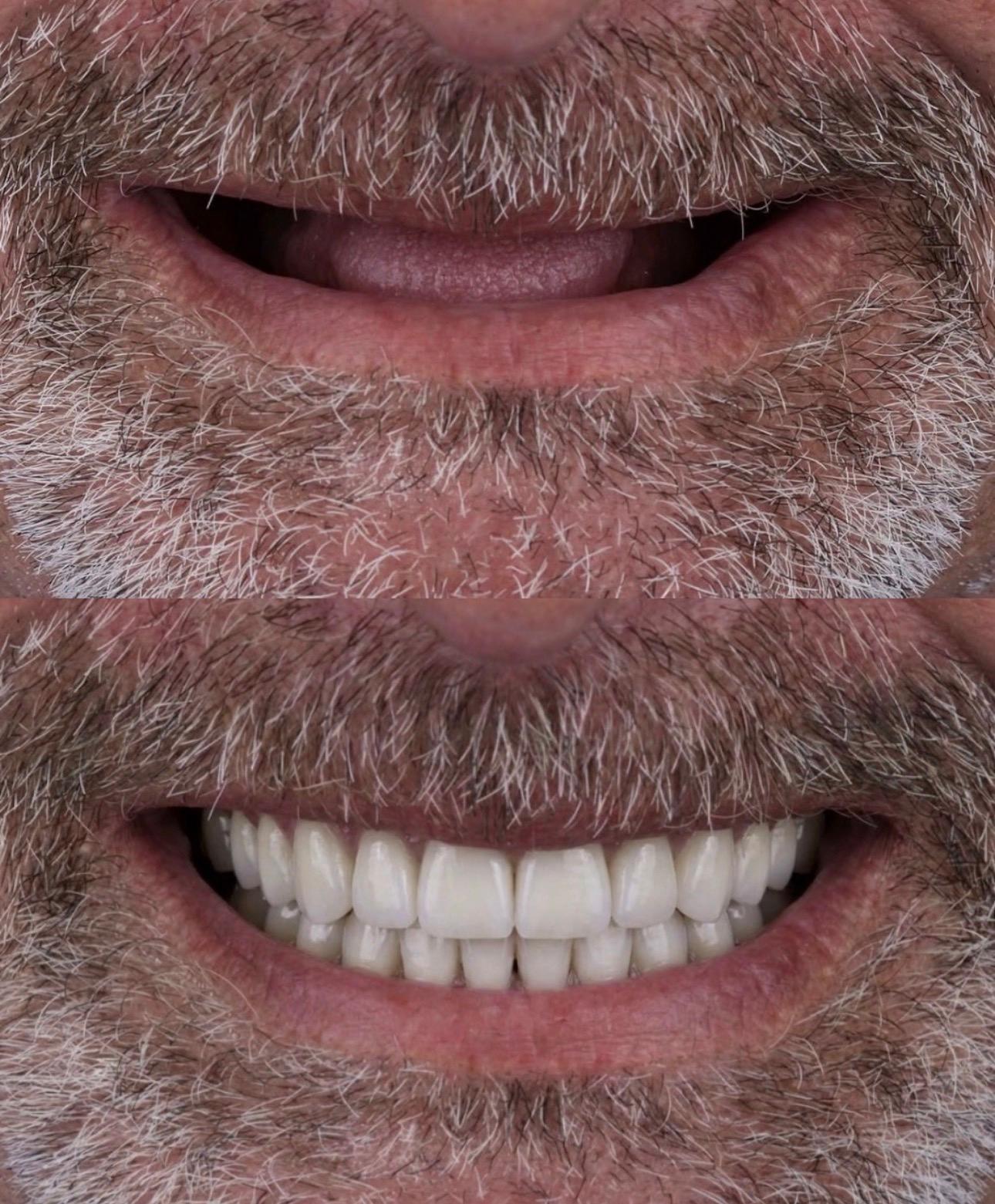 Hasta gülüş dönüşümü 18