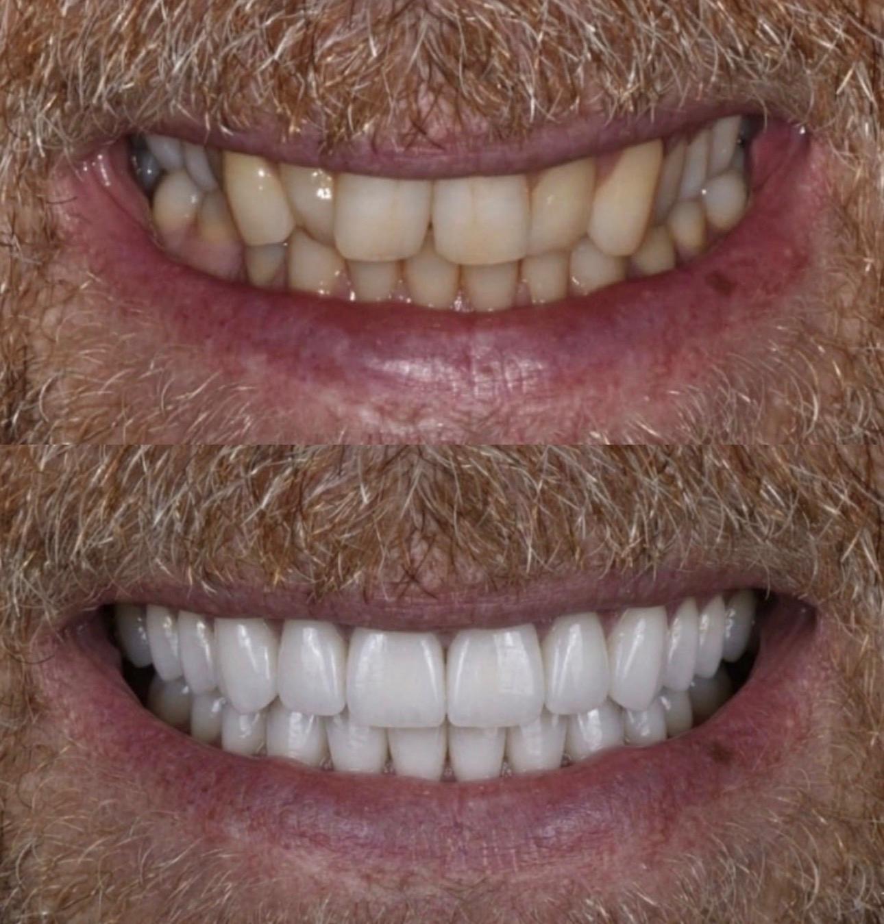 Hasta gülüş dönüşümü 21