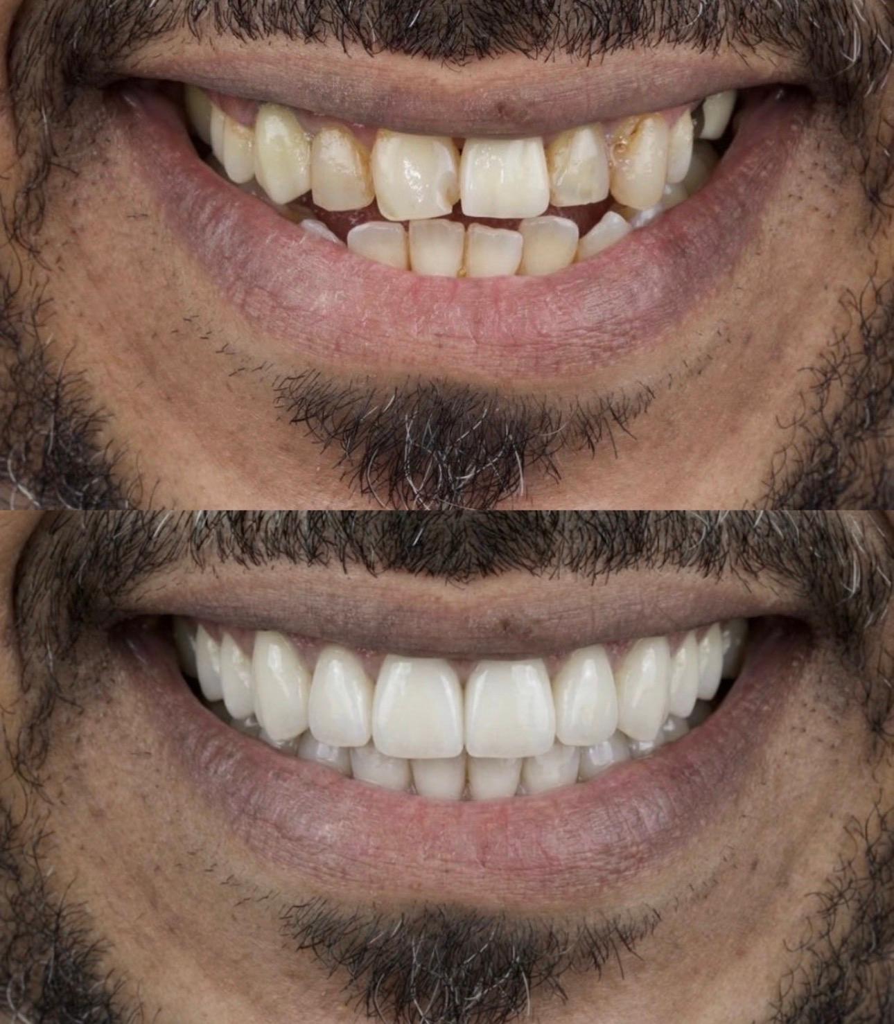 Hasta gülüş dönüşümü 22