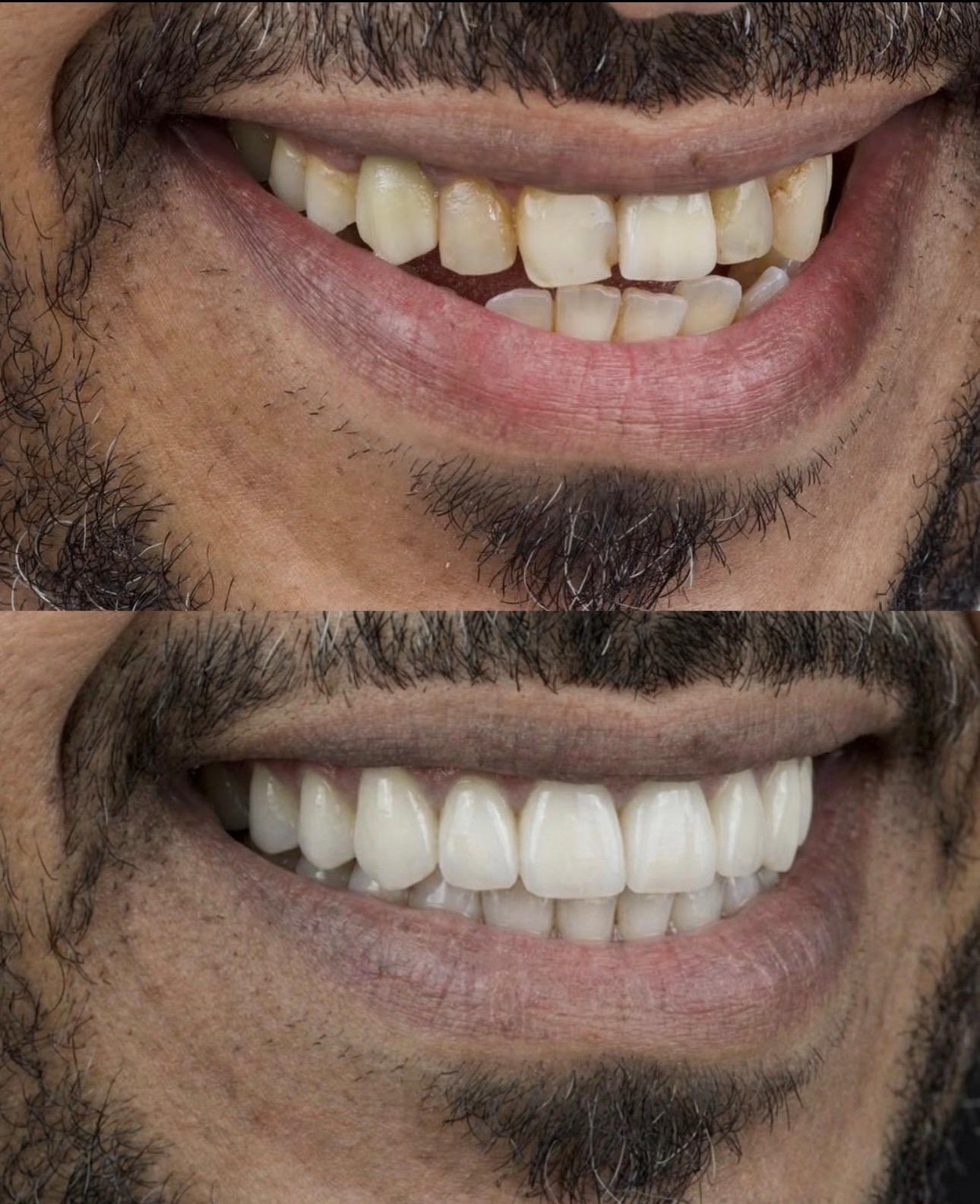 Hasta gülüş dönüşümü 23